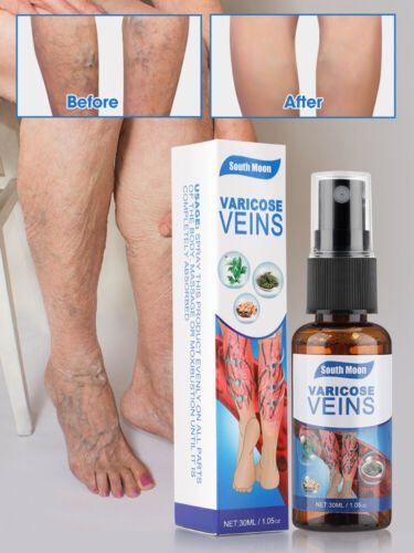 Varicose Veins Relief Spray – Herbal Treatment for Spider &amp; Varicose Veins (30ml)
