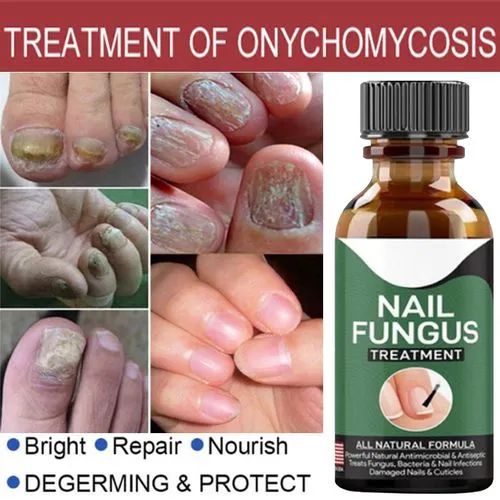 Fast Nail Fungal Treatment Gel