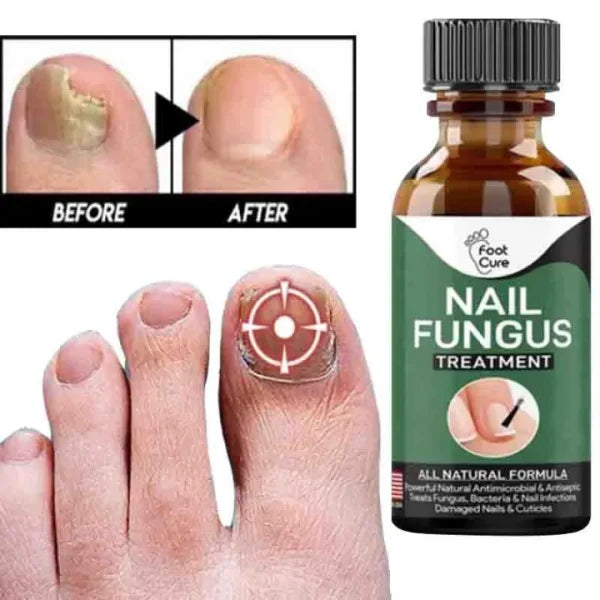 Fast Nail Fungal Treatment Gel